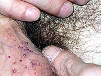 Genital Skin Eruptions and Lesions – Doctor V.