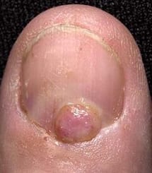 pyogenic granuloma nail
