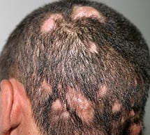 Tinea Capitis (Ringworm, Fungal Scalp Infection, Kerion) – Doctor V.
